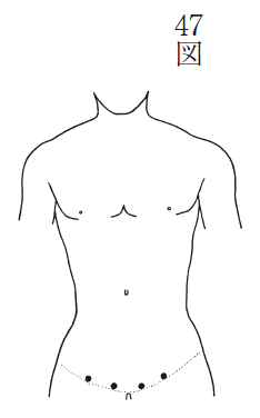 脱腸（ヘルニア）（第47図）